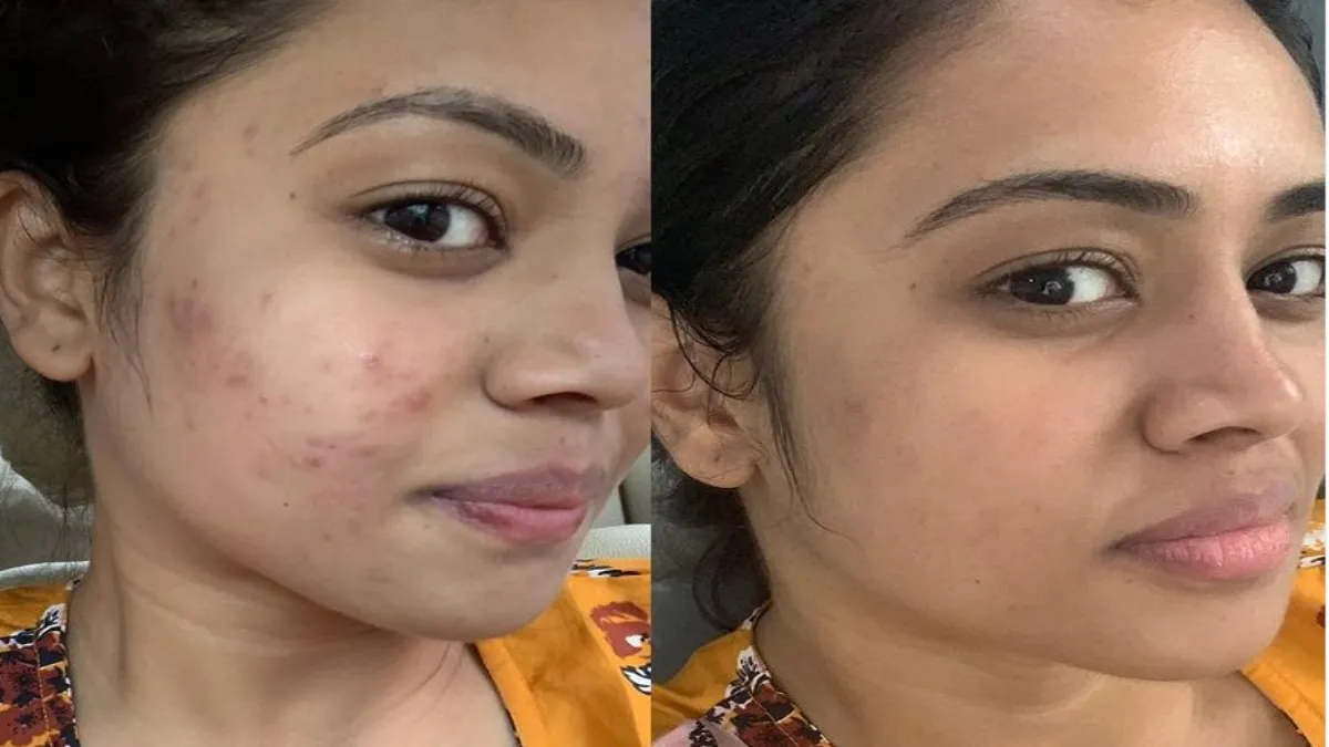 Pandavar Illam Malliga Aarthi Subash shares about her Pimples Tamil News