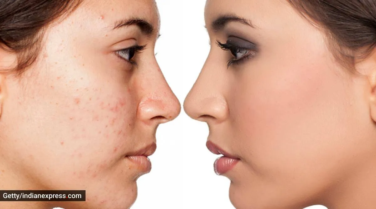 acne-skincare