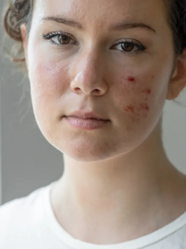 acne - 2 unsplash (1)